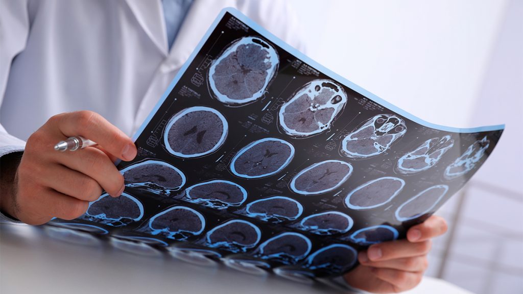 Médico segurando chapa de ressonância magnética de paciente com esclerose múltipla