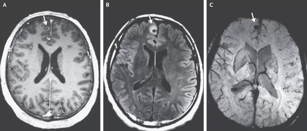 Exames de imagem que diagnosticam a presença do parasita