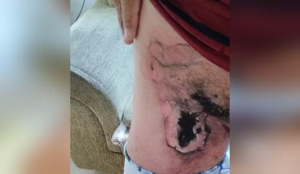 Queimadura na perna do homem