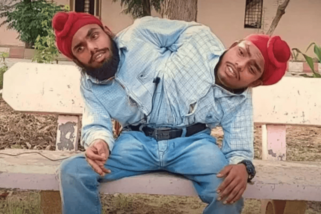 gemeos siameses