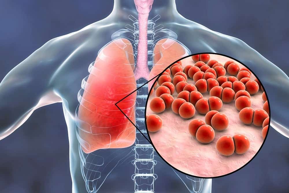 pneumonia