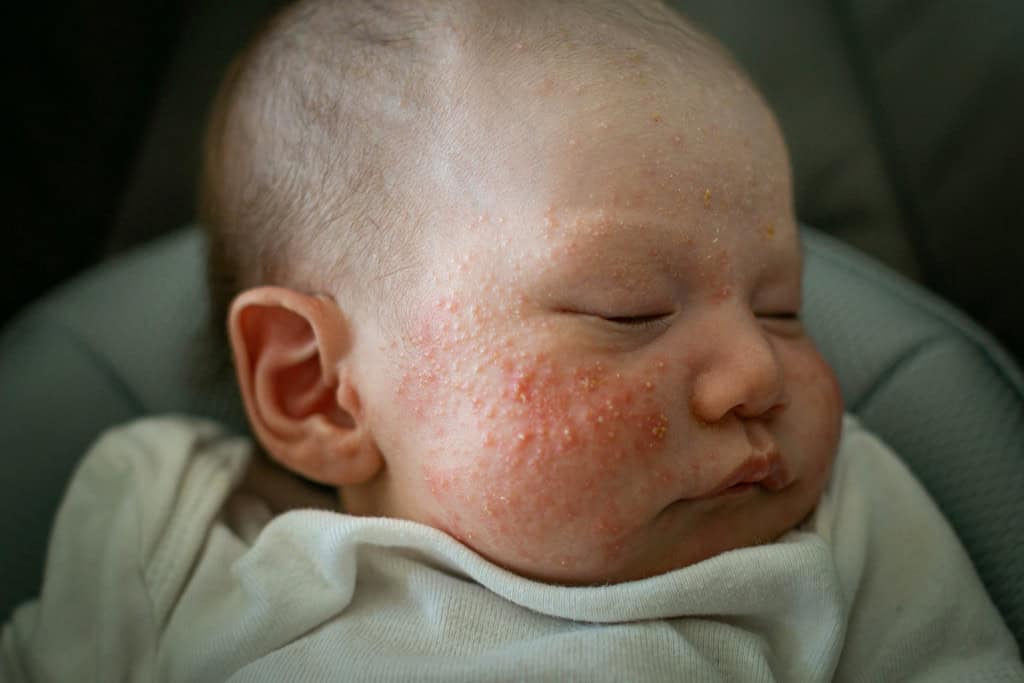 Bebê recém-nascido com acne neonatal