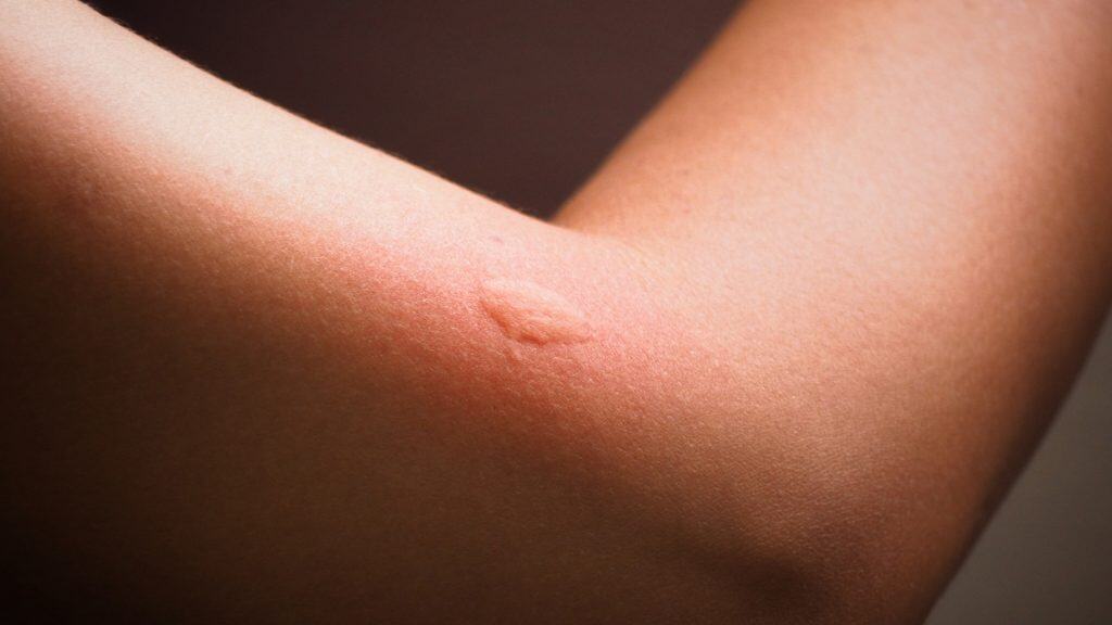 Picada de mosquito pode deixar marca vermelha