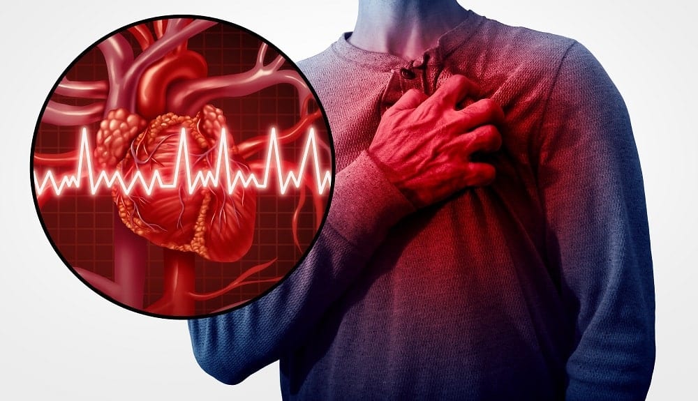 infarto