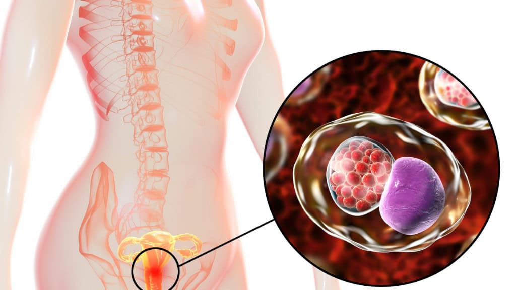Clamidiose feminina, conceito médico. Ilustração 3D mostrando visão ampliada da bactéria Chlamydia trachomatis infectando células do colo do útero.