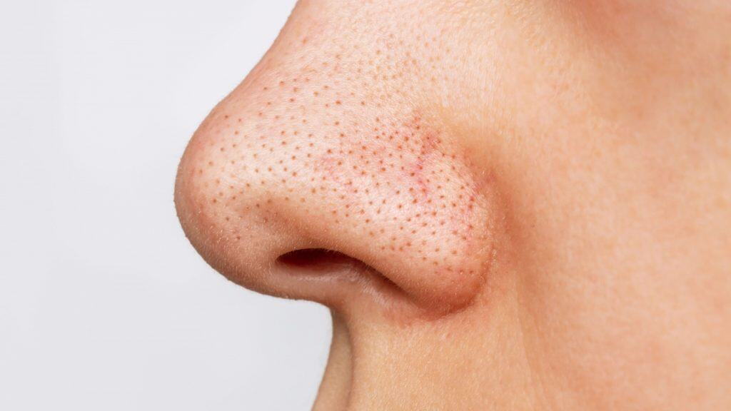 Close-up do nariz de uma mulher com cravos ou pontos pretos isolados em fundo branco. Problema de acne, comedões. Poros dilatados no rosto. Perfil. Conceito de cosmetologia e dermatologia. Macro