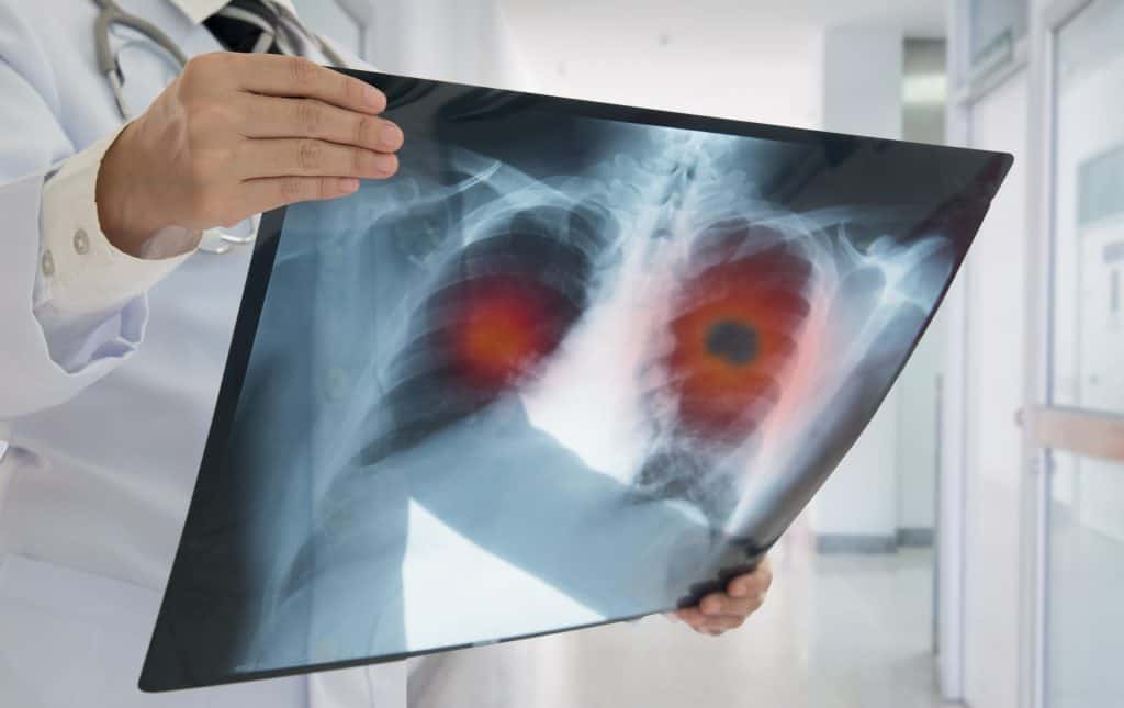 médico segura exame de imagem que mostra problema de saúde no pulmão